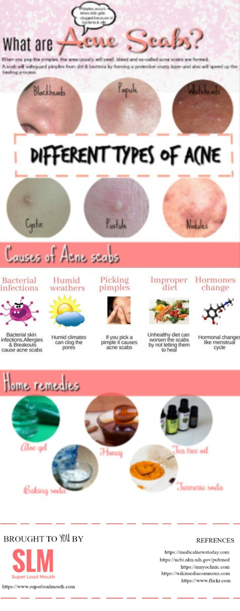 40 Best Ways To Get Rid Of Acne Scabs Overnight DIY Home Remedies