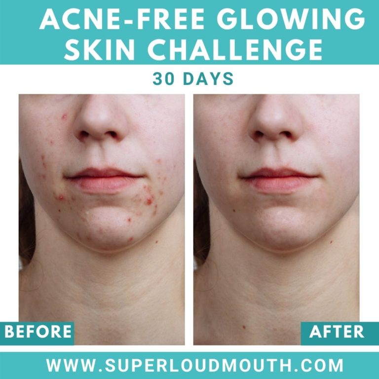 6 Simple Ways to get rid of Acne Naturally Superloudmouth